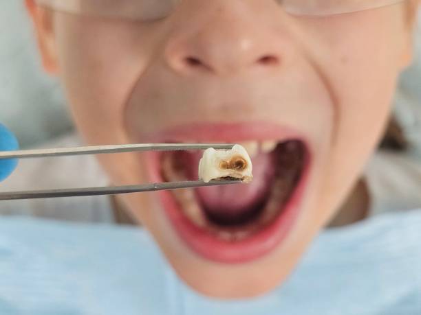 Best Emergency Tooth Extraction in Trevose, PA